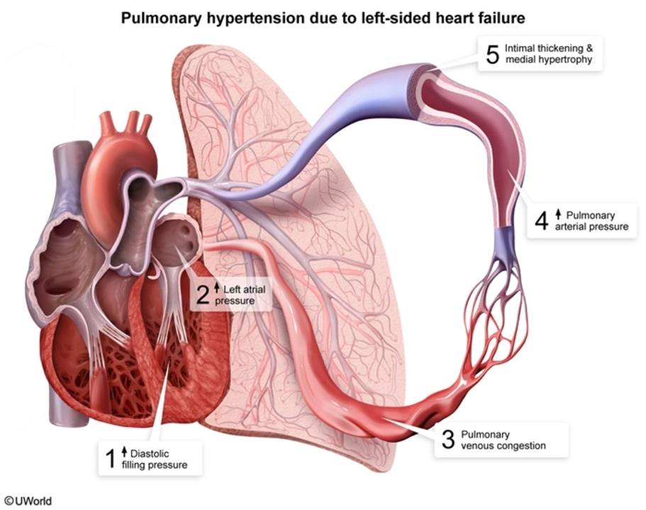 The Latest Research on Pulmonary Arterial Hypertension: Promising New Treatments
