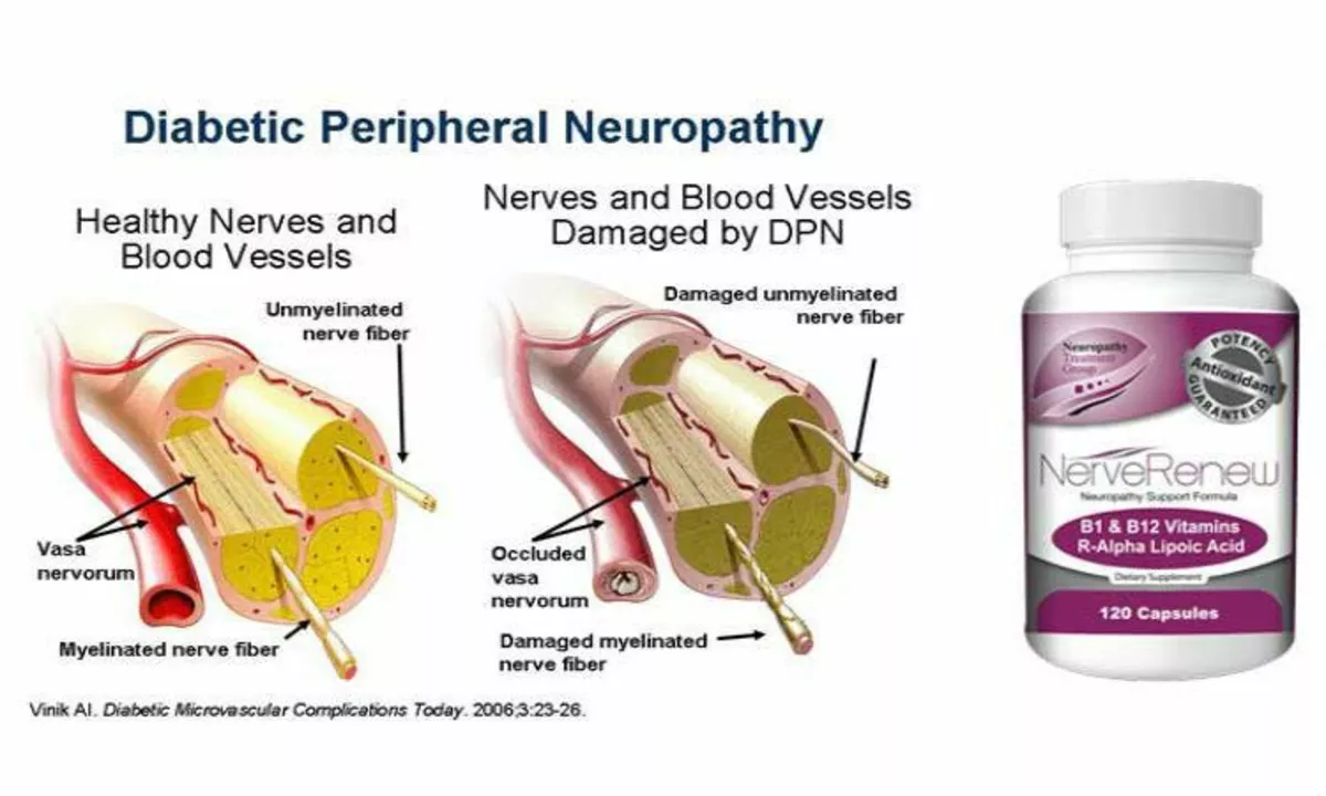 The Link Between Diabetic Peripheral Neuropathy and Cardiovascular Disease