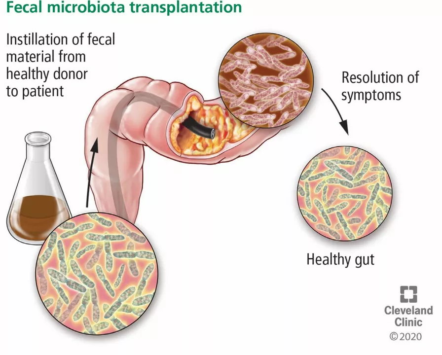 The Role of Fecal Transplant in Treating Chronic Diarrhea
